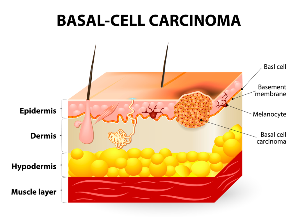 The basal keratinocytes lie at the bottom of the epidermis, directly above the dermis.  This skin cancer is the most common and least deadly as it rarely metastasizes (spreads).