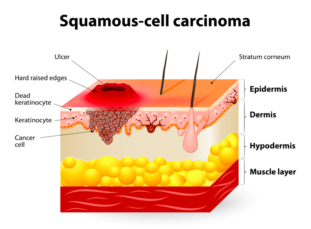 The flattening keratinocytes higher in the epidermis are called squamous cells and they can also mutate and become cancerous.  This  skin cancer is less common than basal cell, but more likely to metastasize.