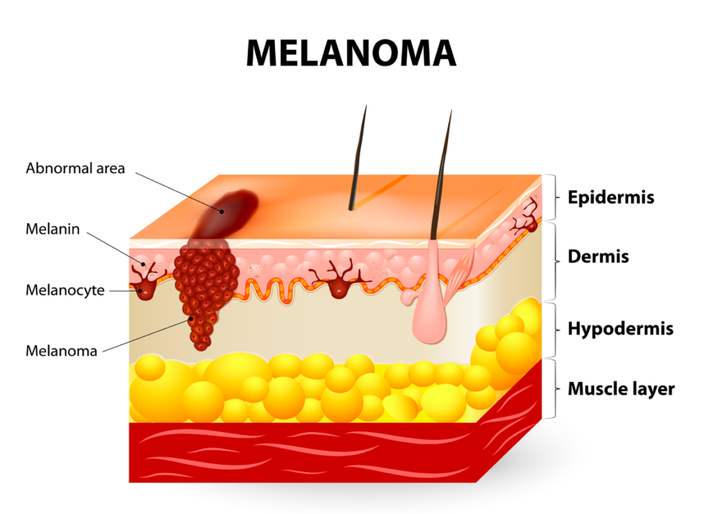 Melanocytes in the epidermis can also mutate.  "Malignant" means capable of spreading, and this skin cancer is the least common, but most likely to metastasize.
