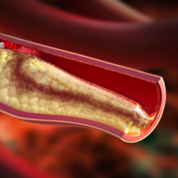 High blood cholesterol can lead to arterial atherosclerosis and increased risk of cardiovascular diseases.